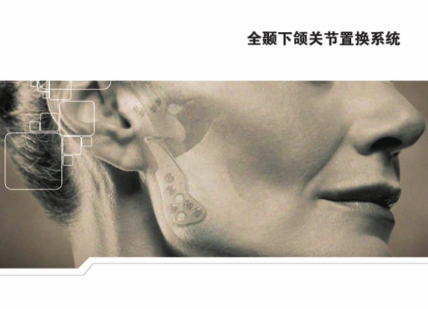全颞下颌关节置换系统